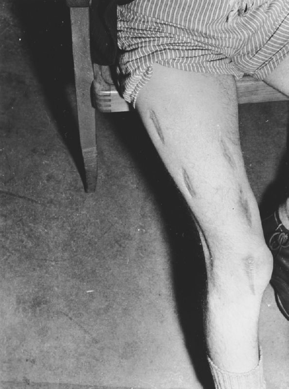 Close-up view of the badly scarred leg of a survivor
